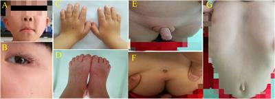 Case Report: Aarskog-scott syndrome caused by FGD1 gene variation: A family study